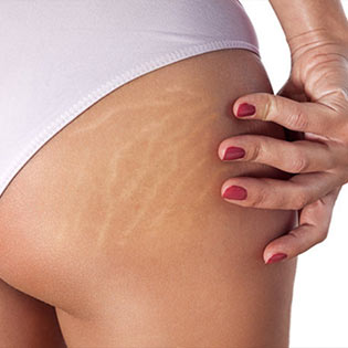 The Best Stretch Mark Treatment You Didn't Know You Needed
